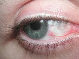 Eye strain and eye fatigue